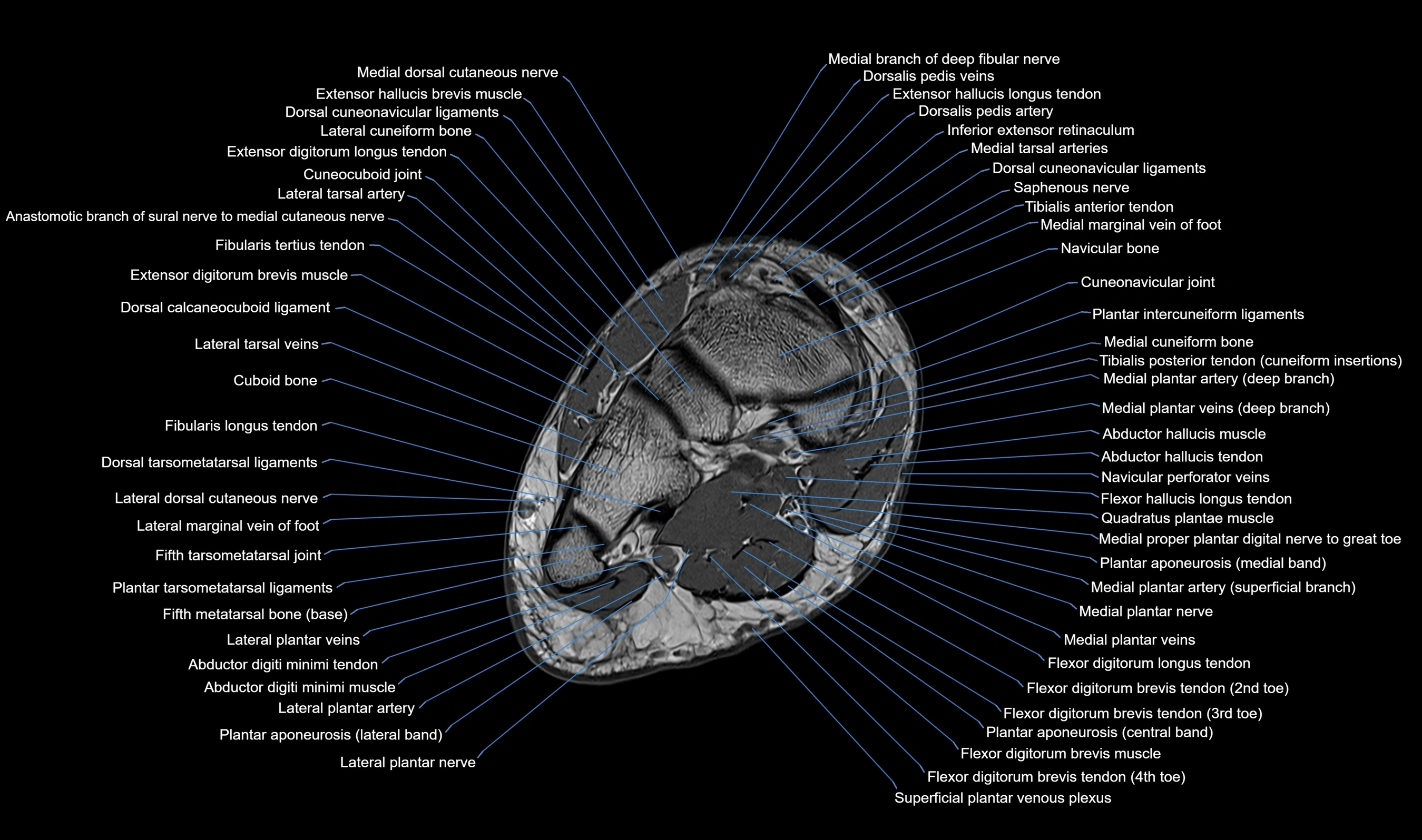 MRI mid foot axial cross sectional anatomy 3T  radiology  image-img-00001-00026.webp
